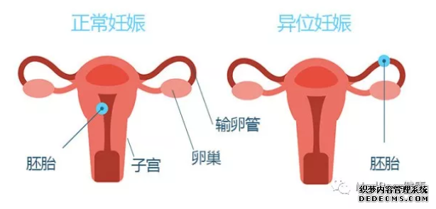 石河子库车县宫外孕患者早期症状有哪些