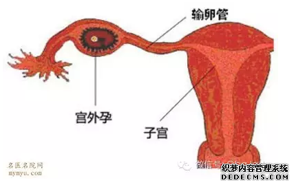 石河子拜城县患上宫外孕会有哪些症状