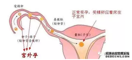 石河子温宿县宫外孕会有哪些早期症状